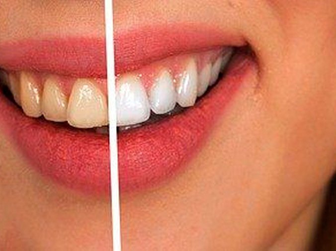 Mitos acerca de los blanqueamientos dentales que vamos a desmentir