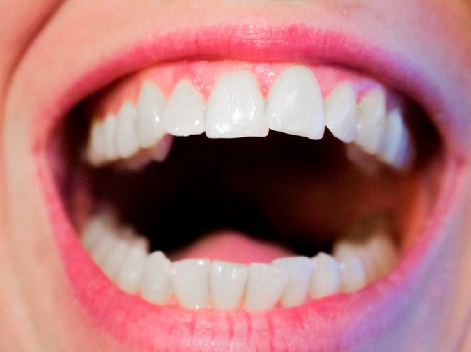 ¿Cuándo se necesita una ortodoncia?