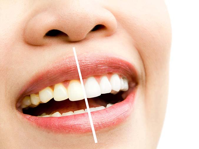 5 beneficios del blanqueamiento dental profesional