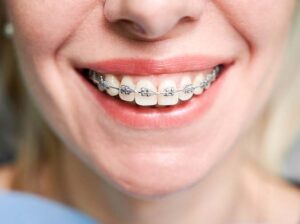 Consejos para limpiar tus Brackets